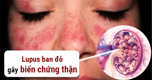 Chẩn đoán bệnh thận lupus