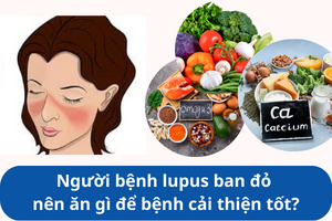 6. Câu hỏi thường gặp về chế độ ăn cho bệnh nhân lupus