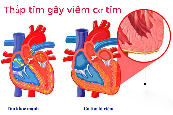 Thấp tim là bệnh lý nguy hiểm gây tổn thương tim