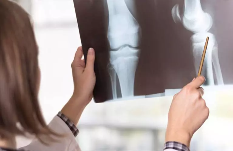 Chụp X-quang giúp chẩn đoán bệnh lý xương khớp
