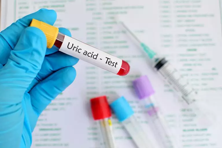 Chỉ số axit uric máu cao có thể gây ra bệnh gì?