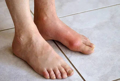 [Giải đáp] Gout gây ra biến chứng gì?