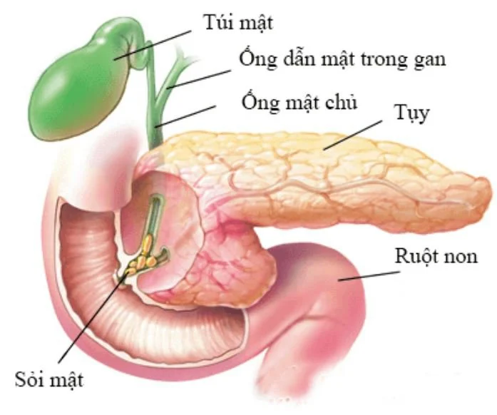 Sỏi ống mật chủ và những điều bạn cần biết?