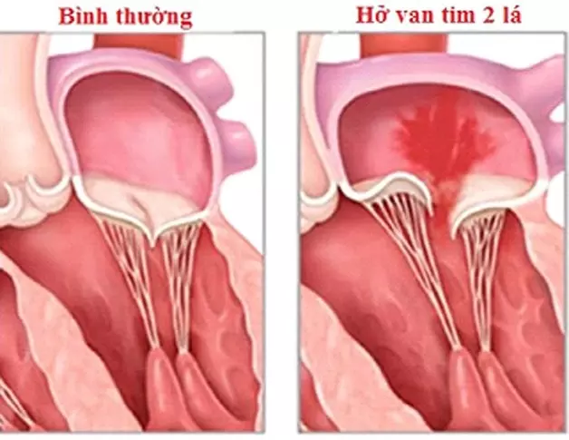 Hở van tim 2 lá có nguy hiểm? Biến chứng và cách phòng ngừa