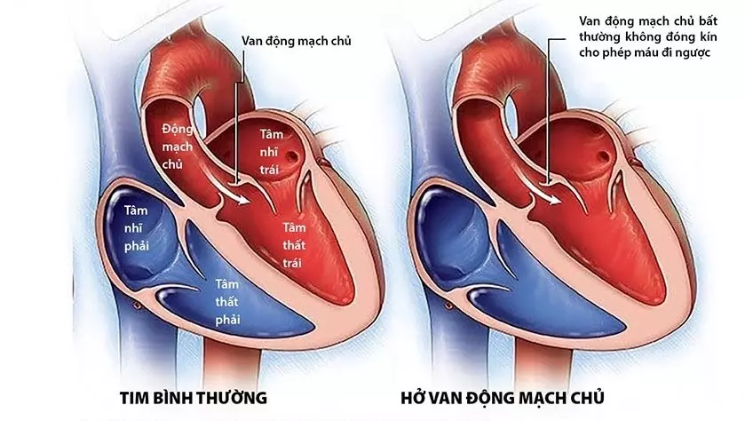 Bị hẹp van động mạch chủ, khó thở thì cần phải phẫu thuật không?