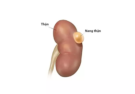 Nang Thận 10mm: Hướng Dẫn Toàn Diện Về Nguyên Nhân, Triệu Chứng Và Điều Trị