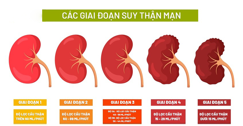 Chỉ số suy thận độ 2: Tất cả những điều bạn cần biết để bảo vệ sức khỏe