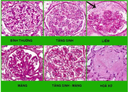 3. Triệu Chứng và Chẩn Đoán