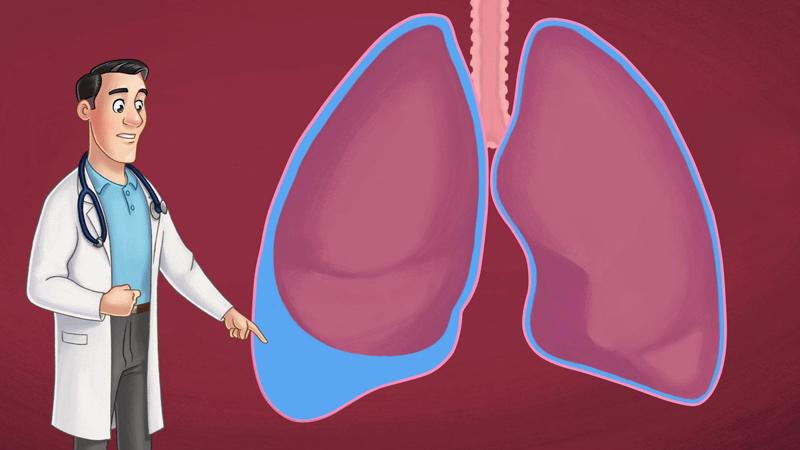 Tình trạng phù trong suy thận mạn có thể gây tràn dịch màng phổi