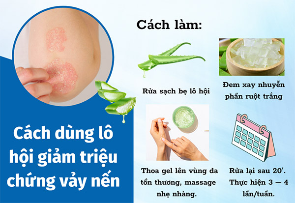 Dùng lô hội giúp giảm nhẹ triệu chứng vảy nến