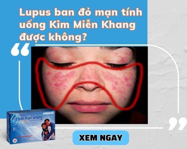 Lupus-ban-do-man-tinh-co-dung-duoc-Kim-Mien-Khang-khong-.jpg