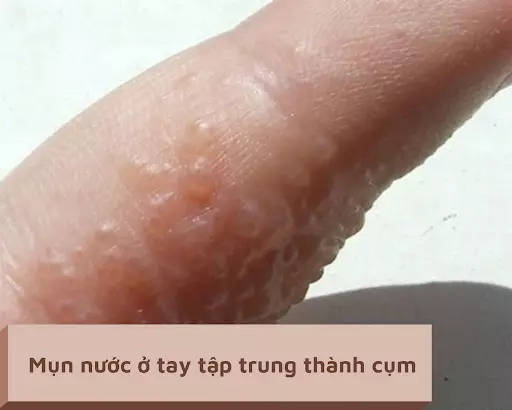 Mụn nước nhỏ tập trung thành những cụm san sát nhau trên tay người bệnh