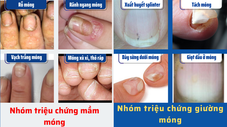 Các triệu chứng của bệnh vảy nến móng tay