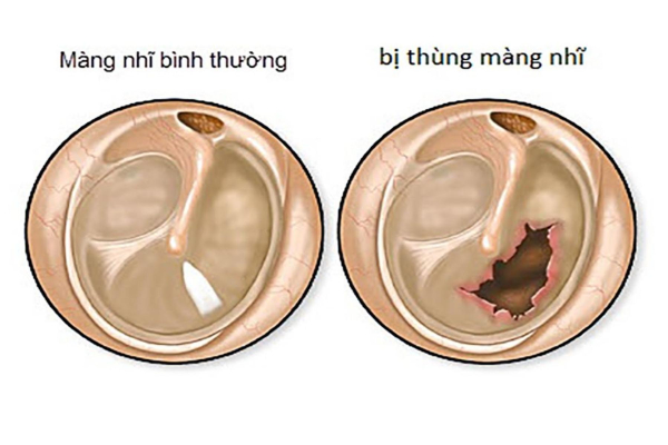 Thủng màng nhĩ gây chảy dịch mủ ở tai kèm đau nhức tai khó chịu