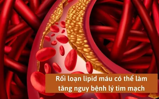Tổng quan chi tiết về rối loạn lipid máu và cách kiểm soát