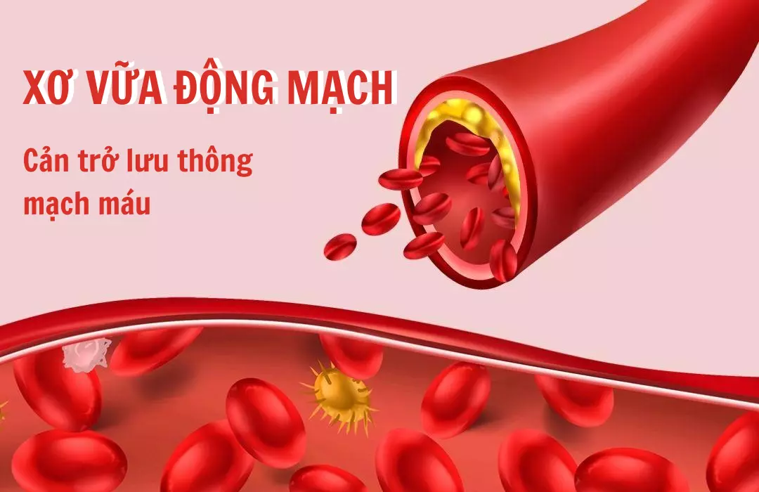 Xơ vữa động mạch: Tổng quan nguyên nhân và cách điều trị