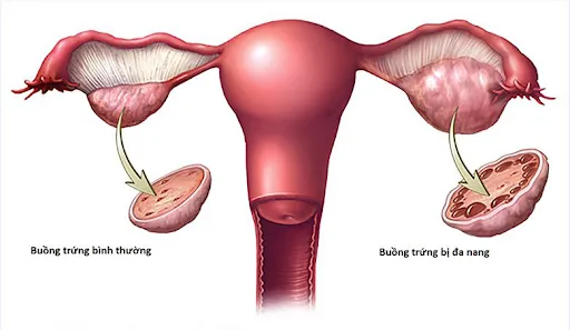 Chị em bị buồng trứng đa nang vẫn có thể mang thai tự nhiên với tỷ lệ thấp