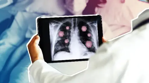 Bệnh viêm phổi bao lâu thì khỏi còn phụ thuộc nguyên nhân gây nhiễm trùng hô hấp là gì