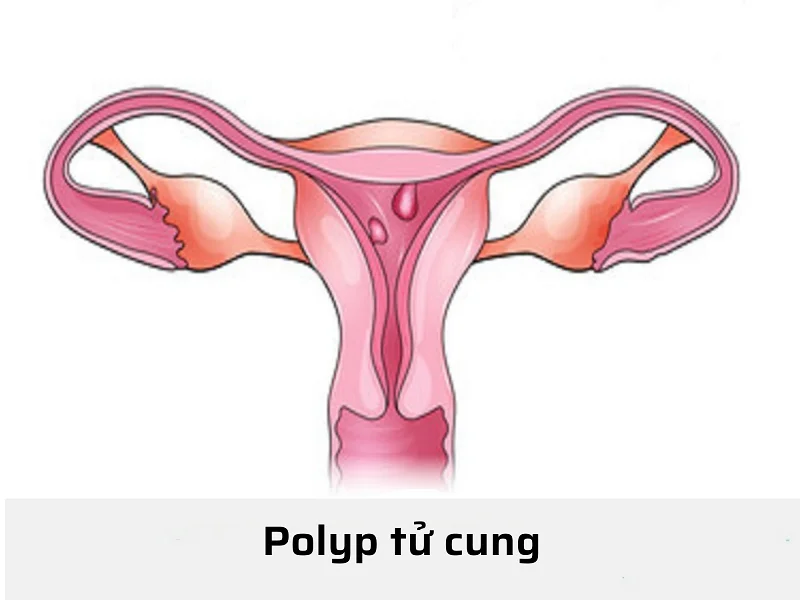 Polyp tử cung: Khám phá bí mật về bệnh và cách điều trị hiệu quả