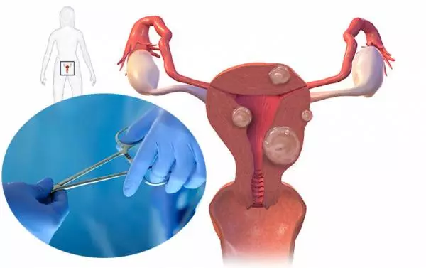Tìm hiểu về phương pháp mổ bóc tách u xơ tử cung!