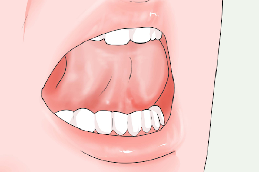Người bệnh đột quỵ nên tập bài tập giãn cơ lưỡi giúp lưỡi linh hoạt hơn