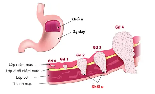 3. Tỷ lệ sống sót sau 5 năm