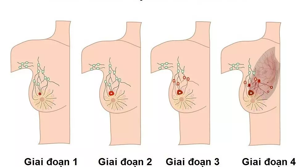 UNG THƯ GIAI ĐOẠN 1 CÓ KHẢ NĂNG CHỮA KHỎI CAO NẾU PHÁT HIỆN SỚM