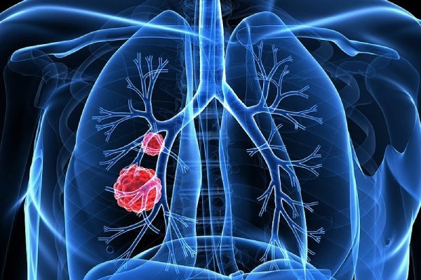U phổi được chia thành 2 loại: U phổi lành tính và ác tính