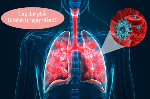 Ung thư phổi là bệnh lý nguy hiểm không được chủ quan
