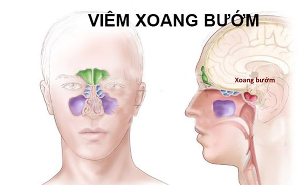 Viêm xoang bướm nguy hiểm thế nào? Chia sẻ từ bác sĩ chuyên khoa