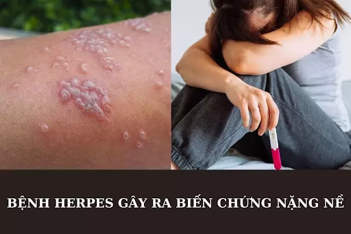 benh-herpes-co-the-gay-ra-nhung-bien-chung-nang-ne.webp