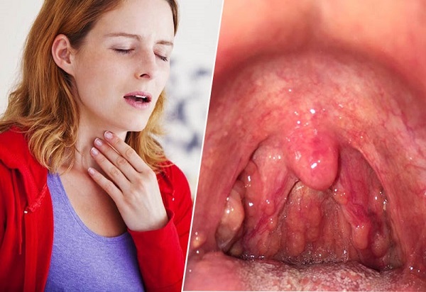 Viêm họng hạt gây ra nhiều triệu chứng khó chịu  