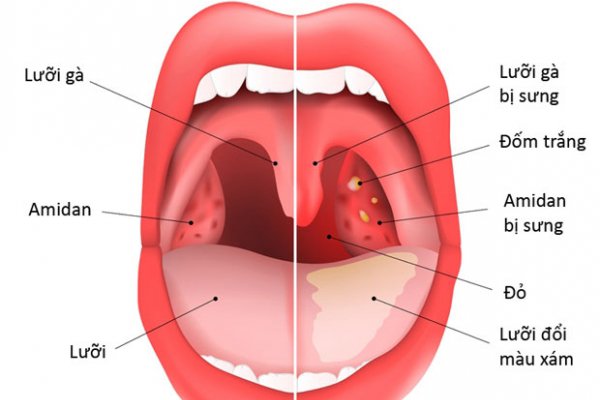 Khối amidan sưng to, phù nề do bị viêm và có thể lan xuống cổ họng