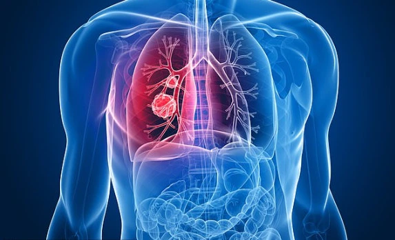 Dấu hiệu cảnh báo bệnh lý ung thư phổi - Tìm hiểu ngay!