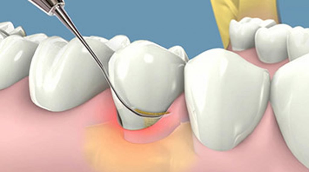 Cao răng được chia thành 2 loại khác nhau