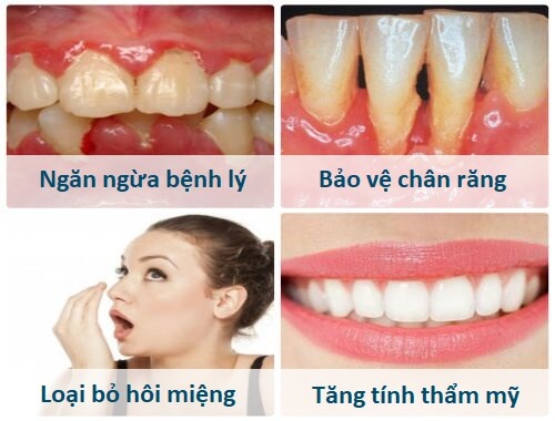 Loại bỏ cao răng mang lại nhiều lợi ích