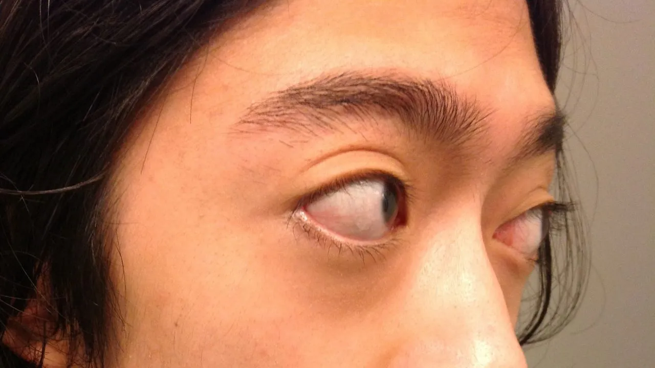 Giải đáp thắc mắc: Lồi mắt do bệnh Basedow phải điều trị thế nào?