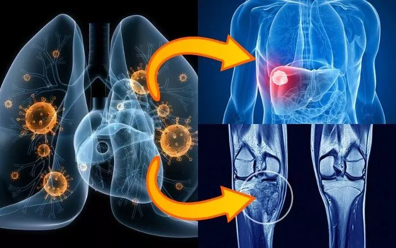 Tế bào ung thư phổi có thể di căn sang bộ phận khác như xương, gan