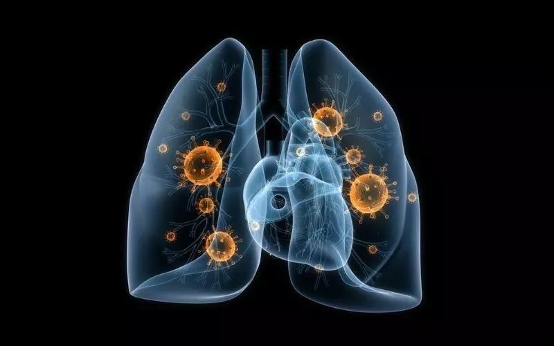 Ung thư phổi tế bào nhỏ có khả năng lây lan nhanh hơn NSCLC