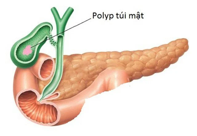 Có 3 polyp túi mật 5mm gây đau bụng nên điều trị thế nào?