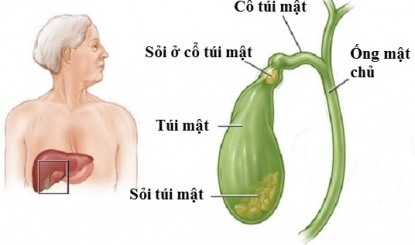 Bệnh án sỏi túi mật 25mm và tiểu đường nên điều trị thế nào?