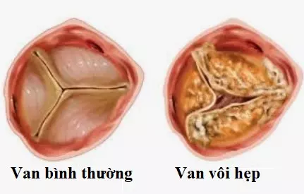 7. Kết Luận và Tầm Quan Trọng Của Kiến Thức Về Vôi Hóa Van Tim