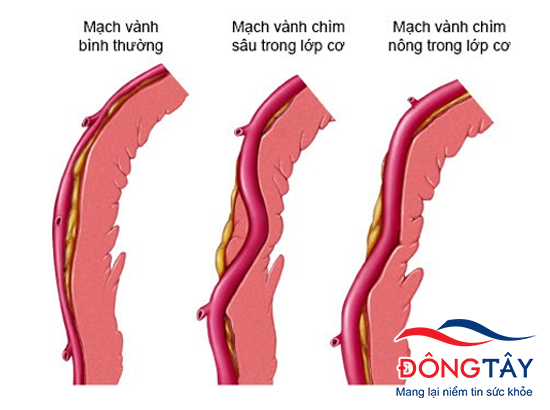 Hình ảnh mô tả cầu cơ trong bệnh mạch vành
