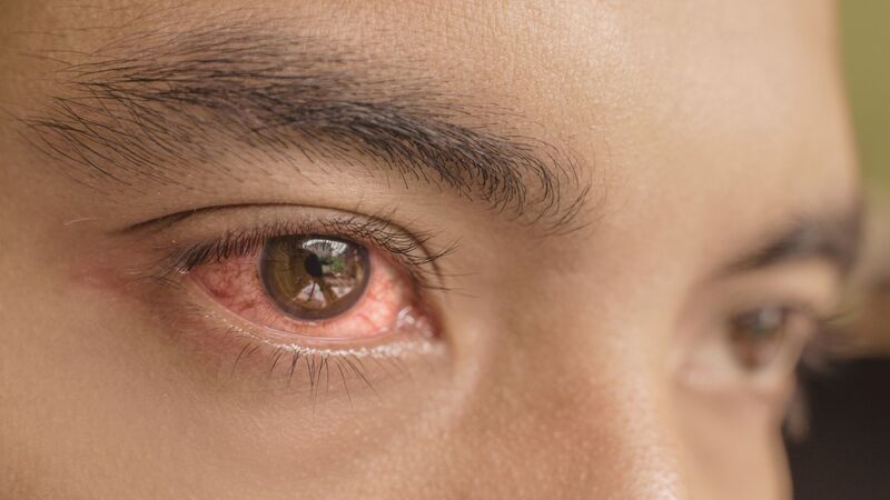 Tiếp xúc trực tiếp với người mắc bệnh là con đường lây nhiễm đau mắt đỏ phổ biến 
