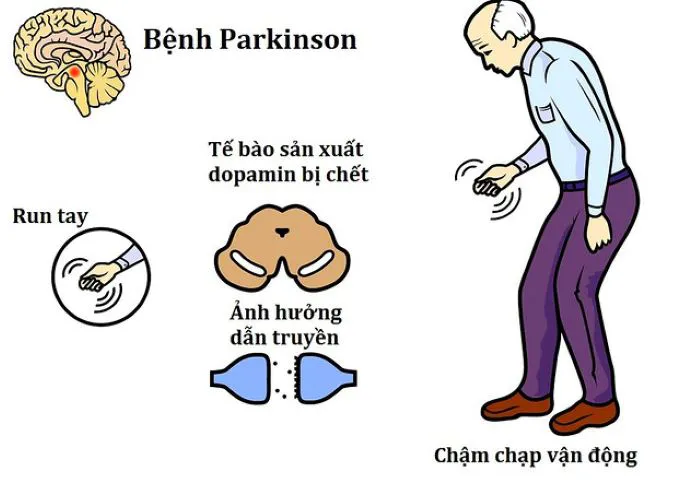 Nhận biết biến chứng nguy hiểm do Parkinson gây ra & cách khắc phục