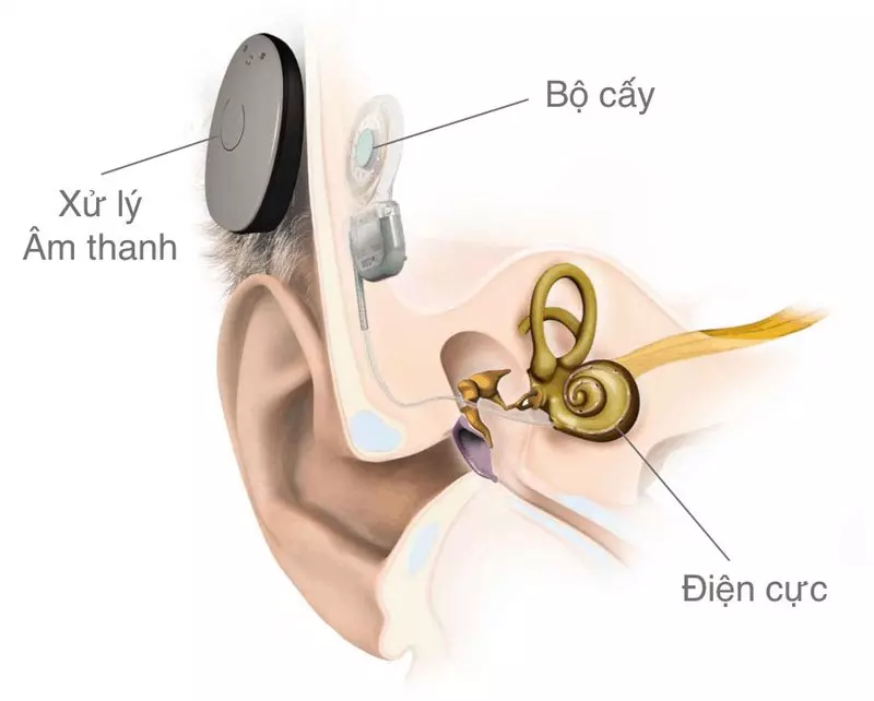 Cấy ghép ốc tai điện tử giúp khôi phục khả năng nghe ở trường hợp bị điếc sâu