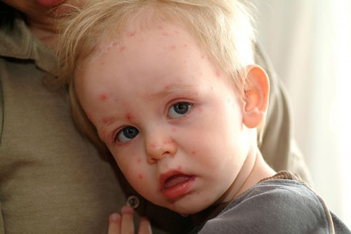 hủy đậu là một trong những bệnh ngoài da do virus thường gặp ở trẻ em.