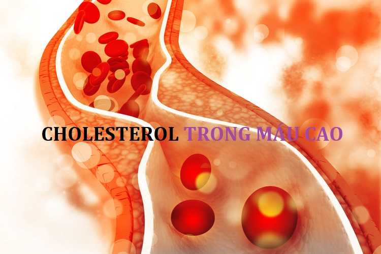 Cholesterol trong máu cao là nguyên nhân gây máu nhiễm mỡ
