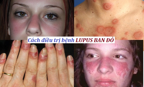 Lupus ban đỏ là bệnh rất nguy hiểm