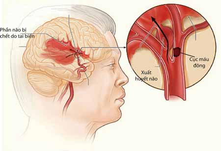 Bệnh tai biến mạch máu não rất nguy hiểm